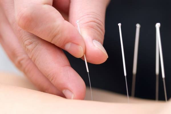 choosing acupuncturist, choose an acupuncturist, find acupunturist