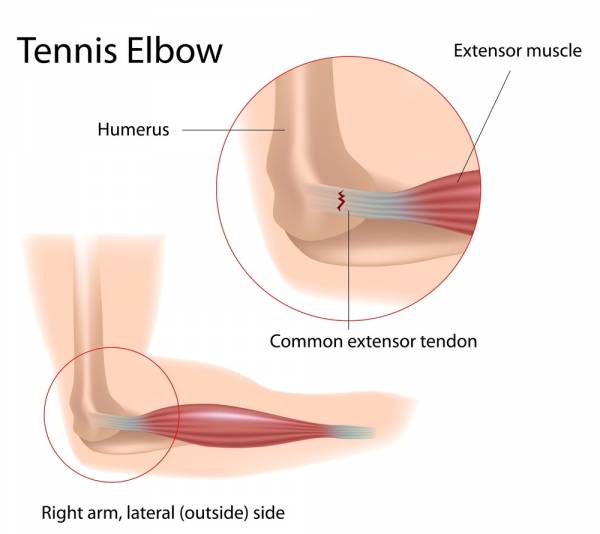 treating tennis elbow, treating elbow tendonitis, healing elbow tendonitis