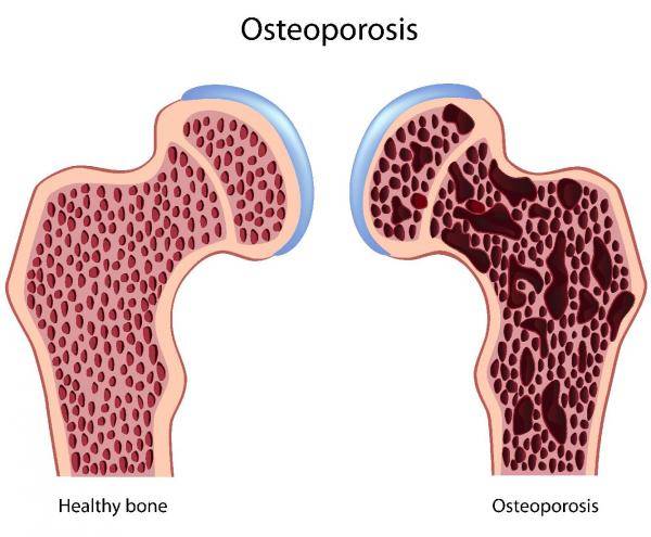 cycling, cycling bad for bones, cycling and bone health, osteoporosis cycling
