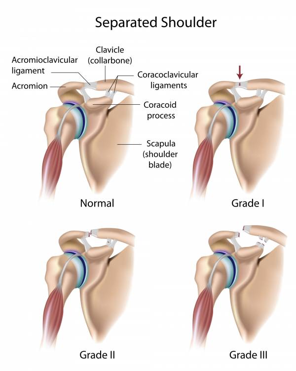shoulder injury, shoulder surgery, rotator cuff, rotator cuff strain