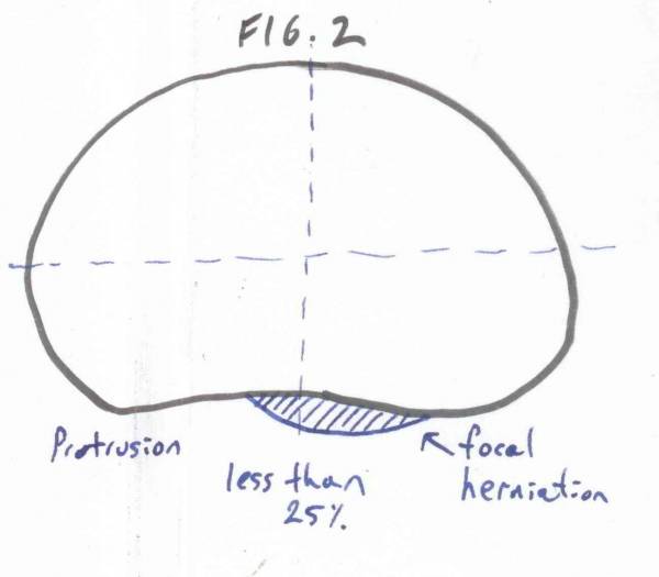 back pain, herniated disc, slipped disc, anatomy, spine anatomy, back pain