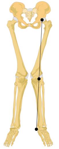 hip problems, valgus knee, trendelenburg gait, athletes and hips, hip injury
