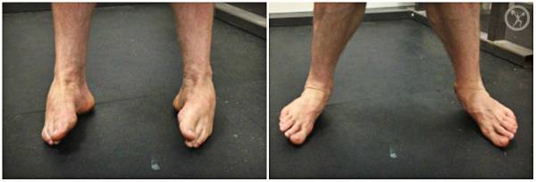 ankle injury, ankle mobility, ankle strains, ankle sprains, healing ankles