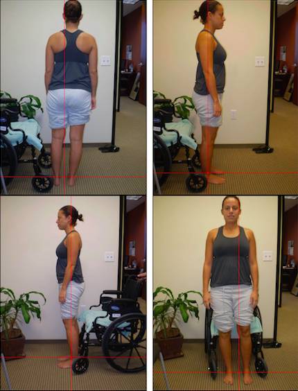 hip pain, alignment, posture, wheelchair, posture alignment therapy