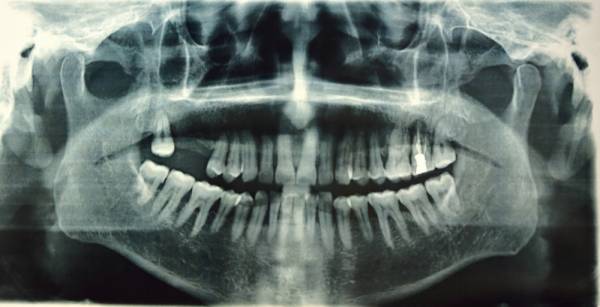 cavities, oral exam, teeth x-ray