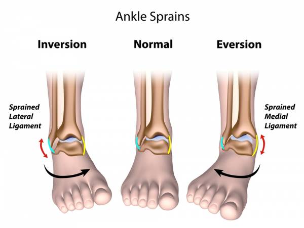 Ankle sprain: recovery process and rehabilitation - Medicofit