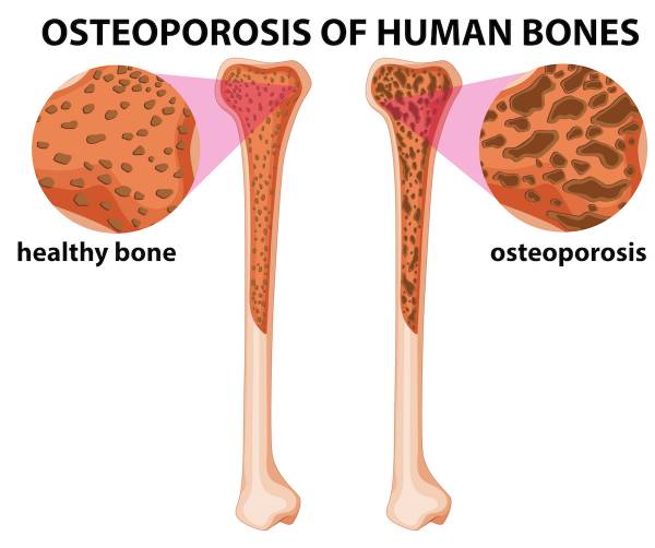 Could new bone forming factor reverse osteoporosis