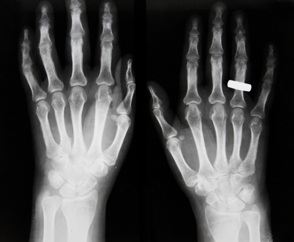 Omega3 Fatty Acids Prevent or Delay Osteoarthritis Breaking Muscle
