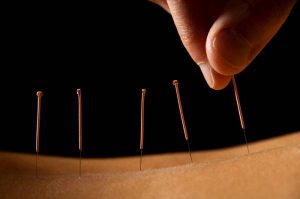 acupuncture, traditional chinese medicine, muscle atrophy