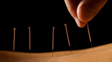 acupuncture, traditional chinese medicine, muscle atrophy