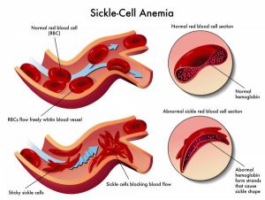 sickle cell, sickle cell anemia, sickle cell trait, sudden death in athletes