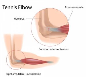 treating tennis elbow, treating elbow tendonitis, healing elbow tendonitis