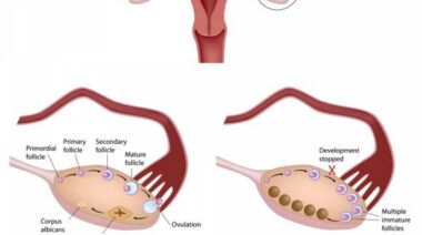 PCOS, PCOS diet, PCOS nutrition, polycystic ovary syndrome