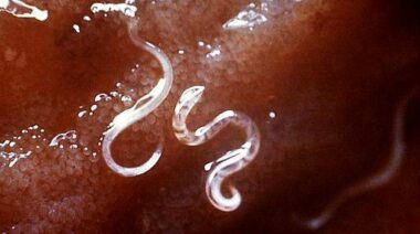 helminth therapy, helminthic therapy, hookworms, autoimmune disease