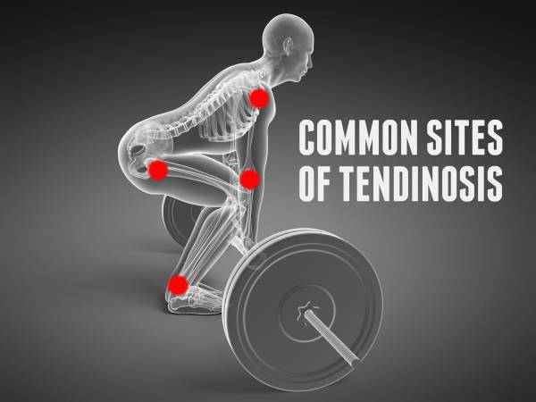 tendinitis is often inaccurately diagnosed