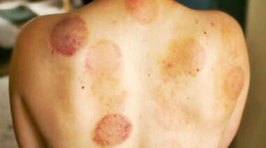 Cupping therapy is a form of alternative medicine.